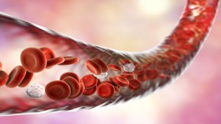 ‘Sessiz katil damar tıkanıklığından 15 dakika kurtulmak mümkün