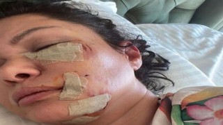 Ünlü şarkıcı Tuğba Altıntop köpek saldırısına uğradı