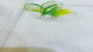 ABDde hastanın gözünden 23 kontakt lens çıkarıldı
