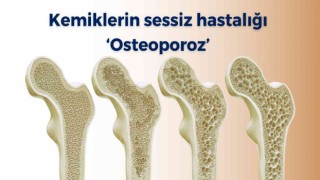 Kemiklerin sessiz hastalığı ‘osteoporoz