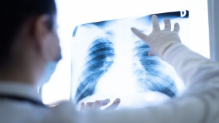 Akciğer kanseri bazen tesadüfen tespit edilebiliyor