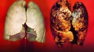 Akciğer kanserlerinin yaklaşık yüzde 90ı tütün ve tütün ürünlerinin kullanımı ile oluşuyor
