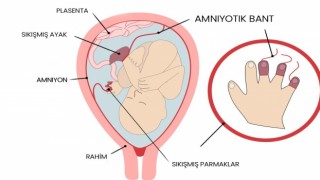 Amniyotik bant sendromu olan bebekler anne karnında ameliyat ile tedavi edilebiliyor