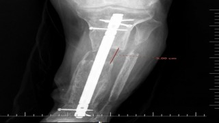 İş kazası geçiren hastaya boy uzatma ameliyatı yapıldı