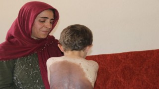 Küçük Samet vücudunu saran dev benlerin tedavi edilmesini istiyor