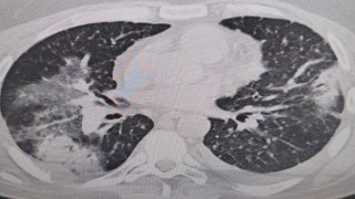 Klimaya bağlı “yaz zatürresine” dikkat