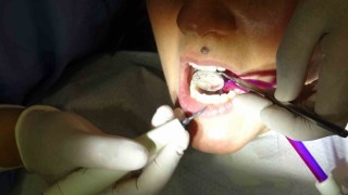 Kanal tedavisi ile dişi kurtarmak mümkün