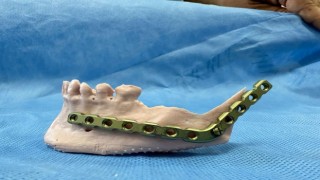 Türkiyede nadir yapılan uygulama ile Sivaslı hasta sağlığına kavuştu