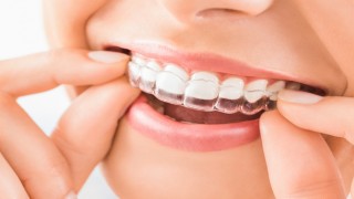İnvisalign Tedavisi Mükemmel Bir Gülümseme İçin Yolculuk
