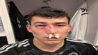 Beşiktaş: Zaynutdinovun burnunda ve göz çukurunda kırık saptanmıştır