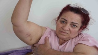 Köpeklerin saldırısına uğrayan kadın: “Ben o an öldüğümü sandım”