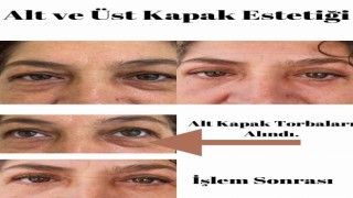 Elmalı Devlet Hastanesinde göz kapağı estetik ameliyatları başladı