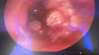 Bursada çocuğun kulağından 2 kurtçuk çıkarıldı