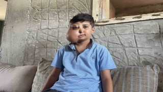 Milyonda bir görülüyor: Yüzündeki Kitle Nedeniyle İki Yüzü Var Gibi Görünüyor