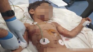 Sokak köpeklerinin saldırdığı 5 yaşındaki Abbas ağır yaralandı