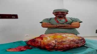 Karın ağrısı şikayeti ile gelen hastanın karnından 26 kilogramlık tümör çıktı