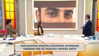 Canlı yayında Enes Güranın gözünün altındaki diş izine dikkat çekildi
