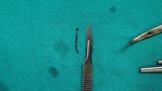 5 yaşındaki çocuğun yuttuğu toplu iğne ameliyatla çıkarıldı