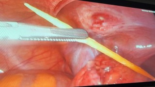 Sinopta 17 yaşındaki bir hastanın kalın bağırsağını delen kürdan kapalı yöntemle çıkarıldı