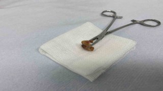 Uykusunda yuttuğu dişler bronşundan çıkarıldı