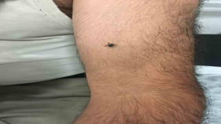 Kayserinin bir ilçesinde daha kene vakası