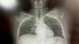 İmplant vidası ciğerine kaçan hasta ölümden döndü