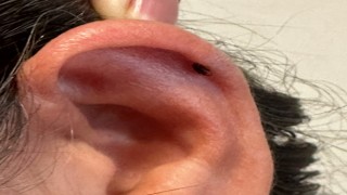 Kadının kulağını kene ısırdı