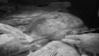 Karın ağrısı şikayetiyle gittiği hastanede karnından 30 santimlik dev kitle çıkarıldı