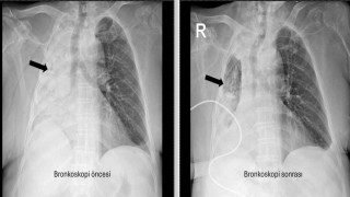 Nefes borusuna kaçan mısır tanesi 5 ay sonra ortaya çıktı
