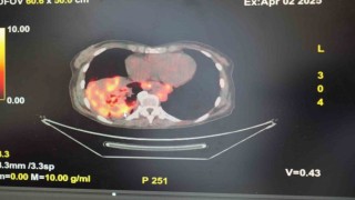 Sigarasız akciğer kanseri vakalarında dikkat çeken artış