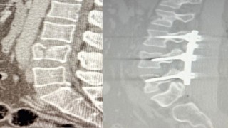 Yüksekten düşen hasta, Patnosta ilk kez uygulanan ameliyatla ayağa kalktı