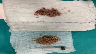 Bayburtta 84 yaşındaki hastanın mesane taşları kapalı yöntemle çıkarıldı