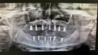 Bayburtta hiç dişi olmayan hasta implant tedavisiyle yeni dişlerine kavuştu