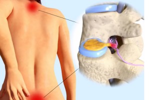 Bel ve Boyun Fıtığında Nükleoplastinin Yeri: Op. Dr. Murat Karakuş ile Akıllı Tedavi Rehberi