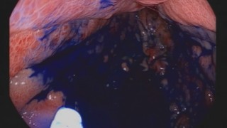 Boyama yöntemi ile mide ve bağırsak kanserinde erken teşhis