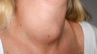 Boynunuzda şişlik varsa dikkat