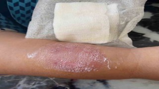 Büyükçekmecede sigara dumanı tartışmasında kolunu ısırdı