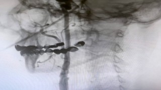 Manisa Şehir Hastanesinde felç riskine karşı ameliyatsız çözüm