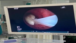 Nefes Borusuna Kaçan Sarımsak Ameliyatla Çıkartıldı