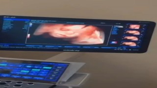 Sinop Atatürk Devlet Hastanesine 4 boyutlu ultrason cihazı