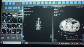 Vandan dünyaya örnek çalışma: Kanser tedavisinde yapay zekâ kullanıldı