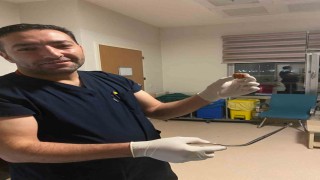 Ağrıda yuttuğu ceviz yemek borusundan çıkarıldı