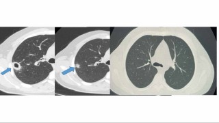 Bayburtta 50 yaşındaki hasta erken tanıyla sağlığına kavuştu
