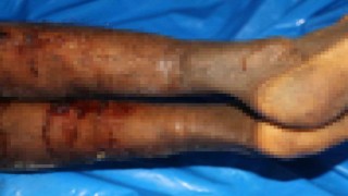 İsrailin iade ettiği cenazelerde işkence izleri görüldü