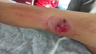 Okula giderken sokak köpeğinin saldırısına uğradı