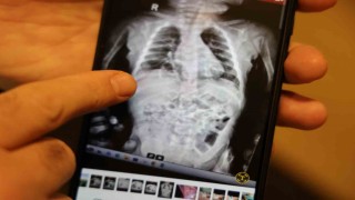 Doğuştan 200 binde bir görülen hastalıkla 2 yıl boyunca yaşayan çocuk sağlığına kavuştu