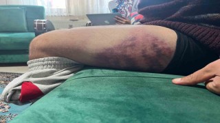 Vicdanları yaralayan olay: Otizmli şahıs odunluğa baktı diye odunla darbedildi