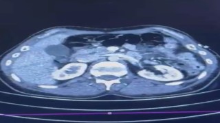 Ülkeye midelerinde uyuşturucu getiren şahıslar yakalandı