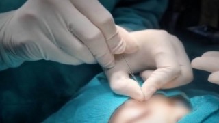 Çukurcada gözyaşı kanalı ameliyatları yapılmaya başlandı
