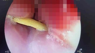 Boğazına saplanan 5 santimlik kemik öldürüyordu